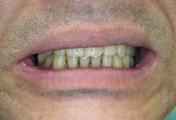 マグネット義歯症例1
