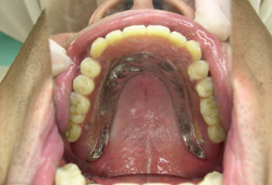 マグネット義歯症例1