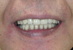 コーヌス義歯症例1