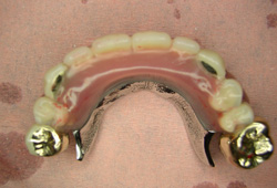 コーヌス義歯症例1