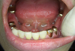 コーヌス義歯症例2