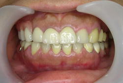 コーヌス義歯症例2