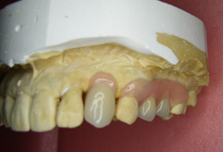ノンクラスプ義歯（フレキサイト）症例1