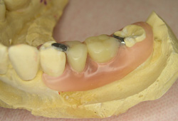 ノンクラスプ義歯（フレキサイト）症例2