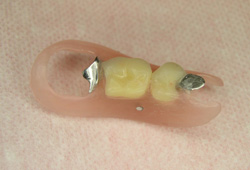 ノンクラスプ義歯（フレキサイト）症例2