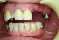 ノンクラスプ義歯（フレキサイト）症例3