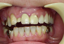 ノンクラスプ義歯（フレキサイト）症例3