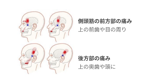 側頭筋(そくとうきん)